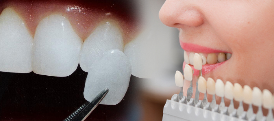CEREC dantų laminatės